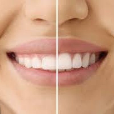 Root Canal Treatment